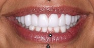 After Image: Case 210 - front