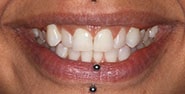 Before Image: Case 210 - front