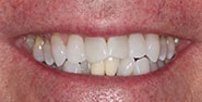 Before Image: Case 211 - front