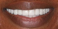 After Image: Case 213 - front