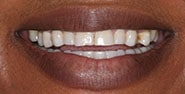 Before Image: Case 213 - front
