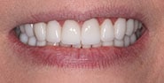 After Image: Case 214 - front