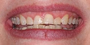 Before Image: Case 214 - front