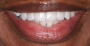 After Image: Case 215 - front