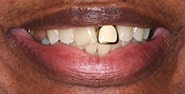 Before Image: Case 215 - front