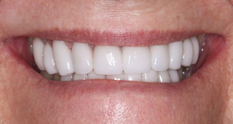 After Image: Case 216 - front