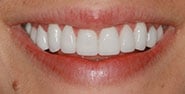 After Image: Case 217 - front
