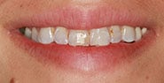 Before Image: Case 217 - front