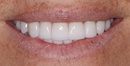 After Image: Case 218 - front