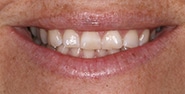 Before Image: Case 218 - front