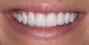 After Image: Case 219 - front