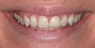 Before Image: Case 219 - front