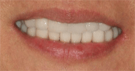 After Image: Case 22 - front