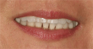 Before Image: Case 22 - front