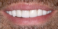 After Image: Case 220 - front