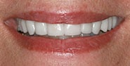 After Image: Case 222 - front