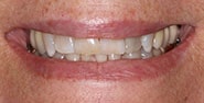 Before Image: Case 222 - front