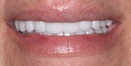 After Image: Case 223 - front