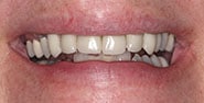 Before Image: Case 223 - front