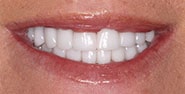 After Image: Case 224 - front