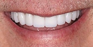 After Image: Case 225 - front