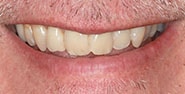 Before Image: Case 225 - front