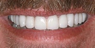After Image: Case 226 - front