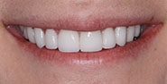 After Image: Case 228 - front