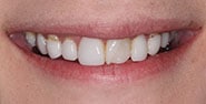 Before Image: Case 228 - front