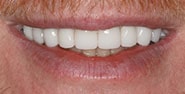 After Image: Case 229 - front
