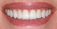 After Image: Case 230 - front