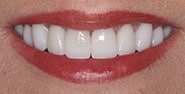 After Image: Case 231 - front