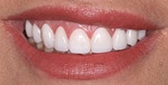 After Image: Case 232 - front