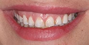 Before Image: Case 232 - front