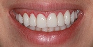 After Image: Case 233 - front