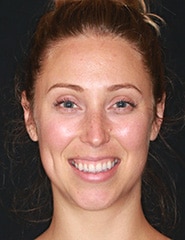 Before Image: Case 233 - front