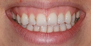 Before Image: Case 233 - front