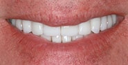 After Image: Case 235 - front