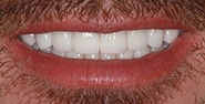 After Image: Case 236 - front