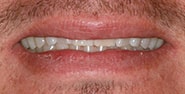 Before Image: Case 237 - front
