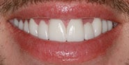 After Image: Case 240 - front