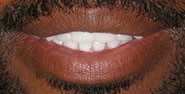 After Image: Case 242 - front