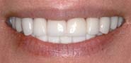 After Image: Case 245 - front