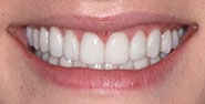 After Image: Case 249 - front