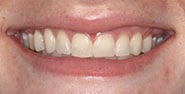 Before Image: Case 249 - front