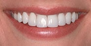 After Image: Case 250 - front