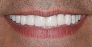 After Image: Case 252 - front