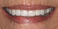After Image: Case 254 - front