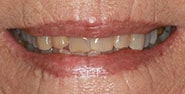 Before Image: Case 254 - front