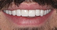 After Image: Case 255 - front